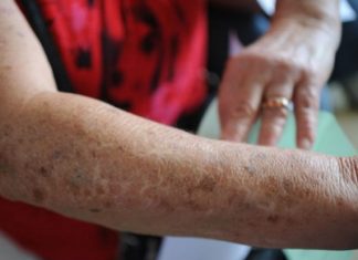 Dezembro Laranja: como identificar os primeiros sinais do câncer de pele