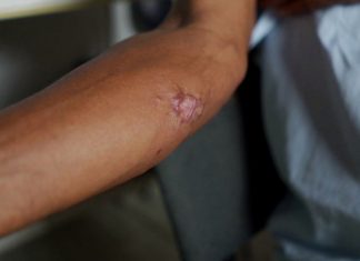 Estudantes do Instituto Federal de Rondônia criam ‘biopomada’ para tratar leishmaniose