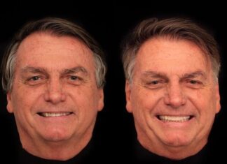 Jair Bolsonaro abre o jogo sobre pagamento de harmonização dentária