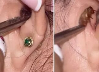 Médica retira barata de ouvido de paciente e vídeo viraliza; assista