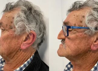 Idoso recebe prótese facial após viver dois anos sem nariz devido a câncer