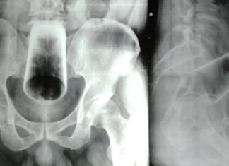 Homem é internado às pressas após enfiar copo de vidro no ânus