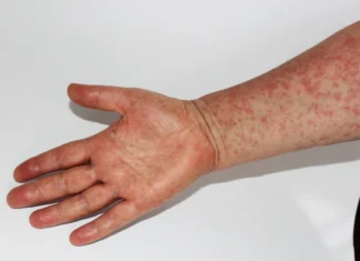 Sarampo volta a preocupar: veja o que você precisa saber sobre a doença