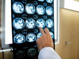 Veja os cuidados para se prevenir do AVC: doença cresce entre mulheres com menos de 50 anos