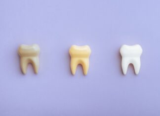 5 mitos e verdades sobre manchas nos dentes
