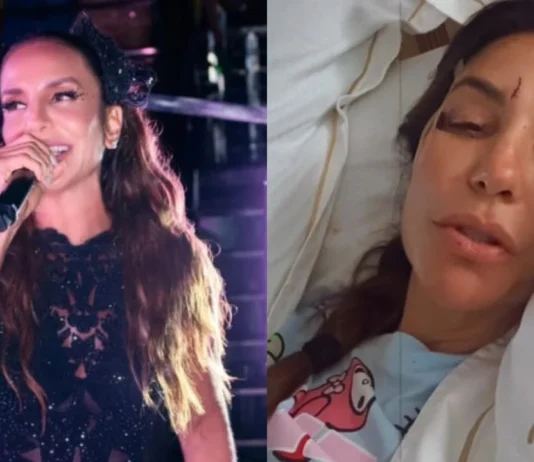 Após ser internada, Ivete Sangalo surge com rosto ferido e explica estado de saúde: ‘Caí com tudo’
