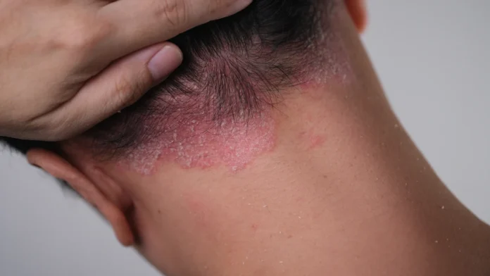 uma-das-doencas-listadas-e-a-dermatite-seborreica-2737738-article